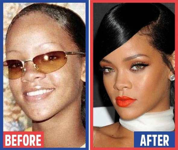 Celebrity plastic surgery procedures - before and after photos