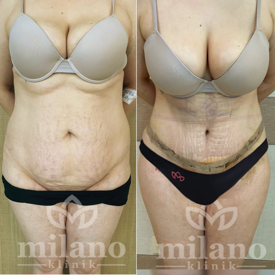 Risultato di una paziente della Milano Clinic – prima e dopo