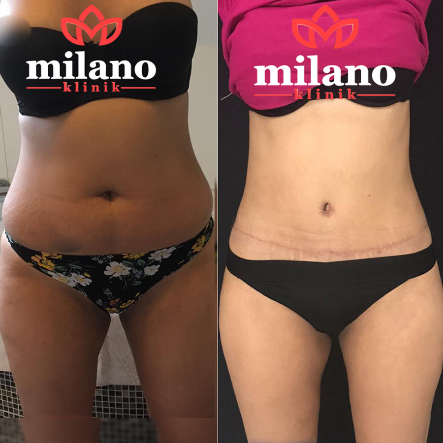 Risultato di una paziente della Milano Clinic – prima e dopo