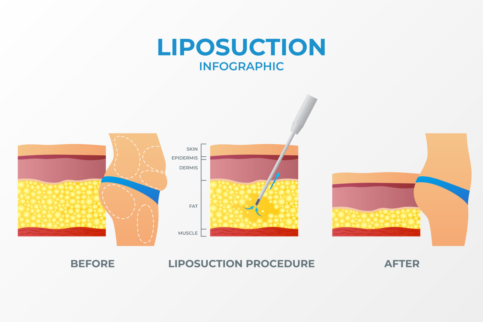Liposuction Liposuction Cost Turkey Liposuction Surgery Istanbul