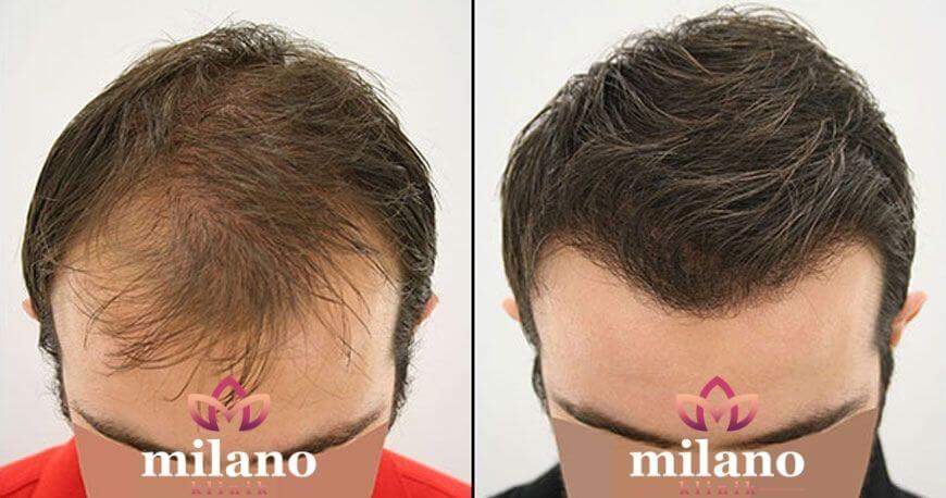 fue hair transplant in Turkey