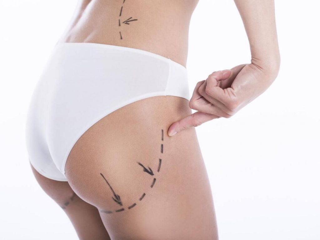Chirurgie Fessier