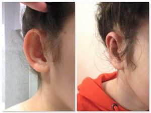 Otoplastie Turquie