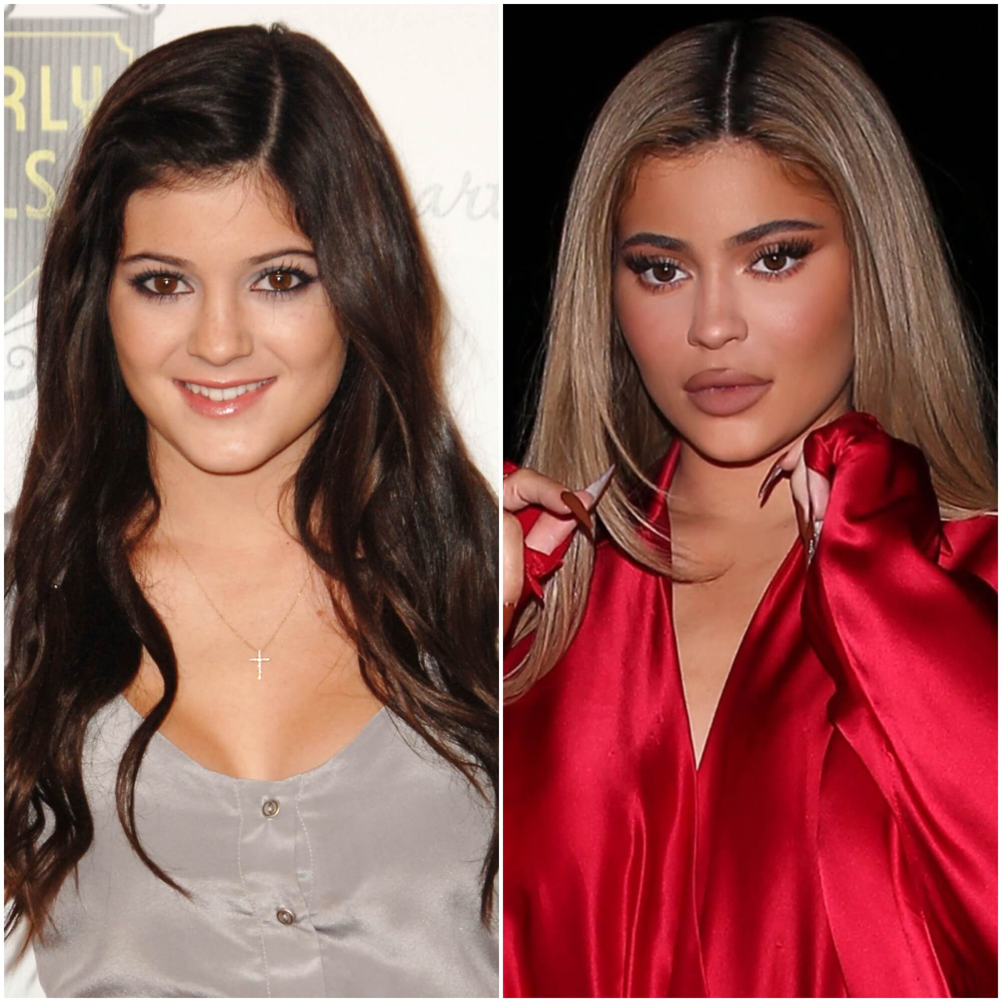 Kylie Jenners Schönheitsoperationen