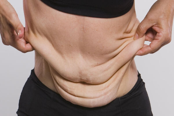 Sagging After Weight Loss
