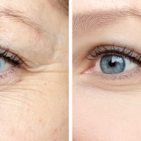 meilleurs traitements anti âge des yeux