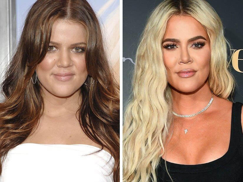 Khloé Kardashian Plastic Surgery