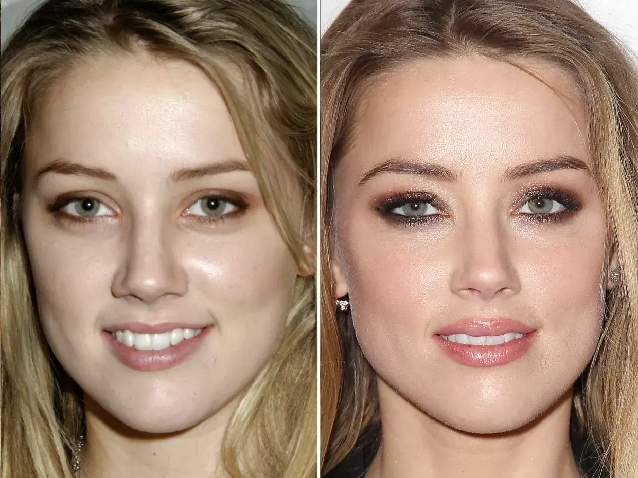 Amber Heard Plastic Surgery