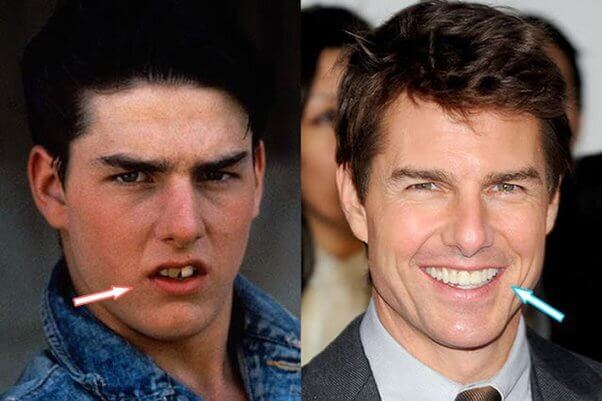 Les chirurgies plastiques de Tom Cruise
