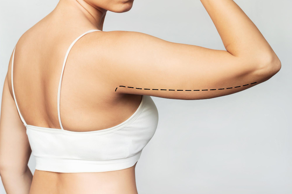 cropped-shot-young-woman-with-excess-fat-her-upper-arm-with-marks-liposuction-surgery