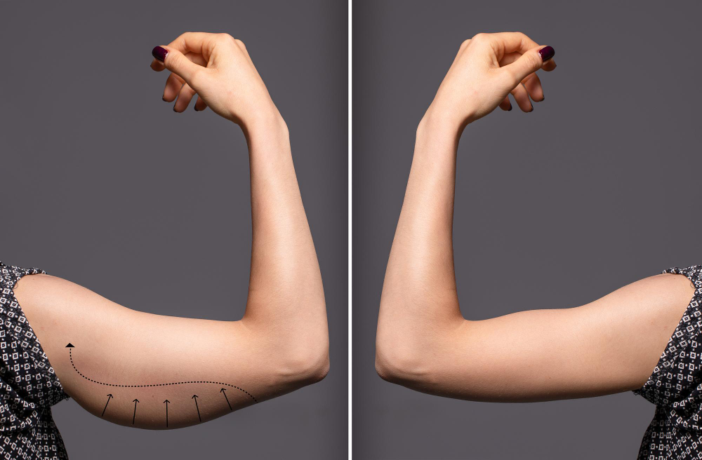woman-arms-with-bat-wings-comparison-before-after-brachioplasty-surgery (1)