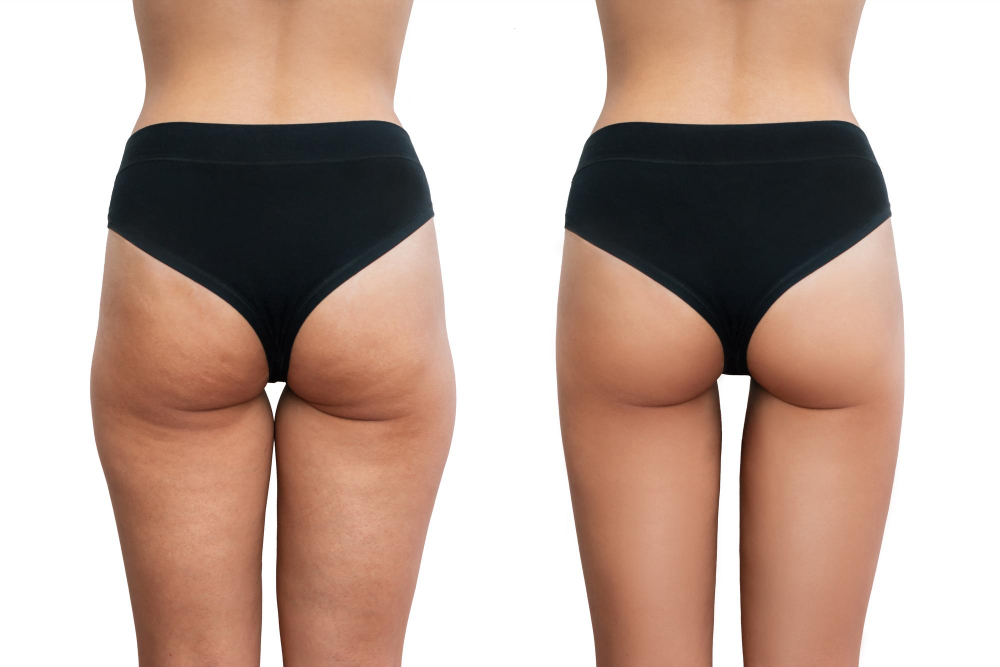 young-woman-s-thighs-with-cellulite-before-after-treatment-isolated-white-background