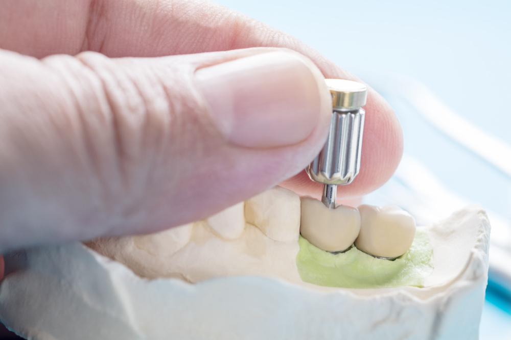 closeup-convertible-abutment-components-dental-implant-temporary-abutment-abutment-screw