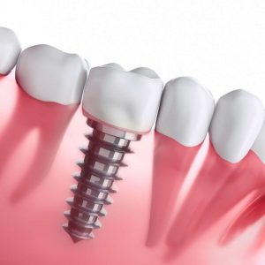 Dinge, die vor und nach der Zahnimplantation zu beachten sind