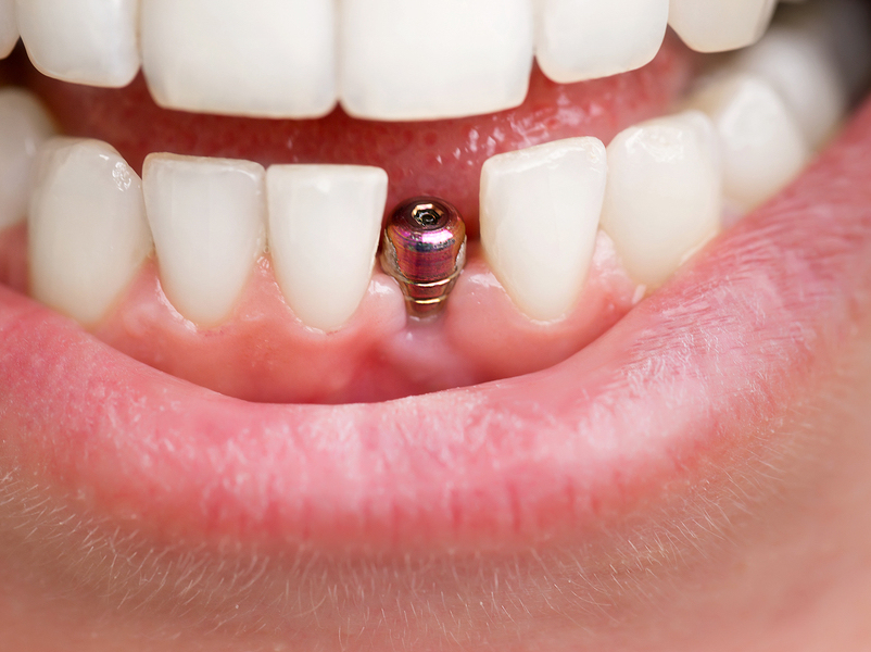 Things to Consider Before and After Dental Implant