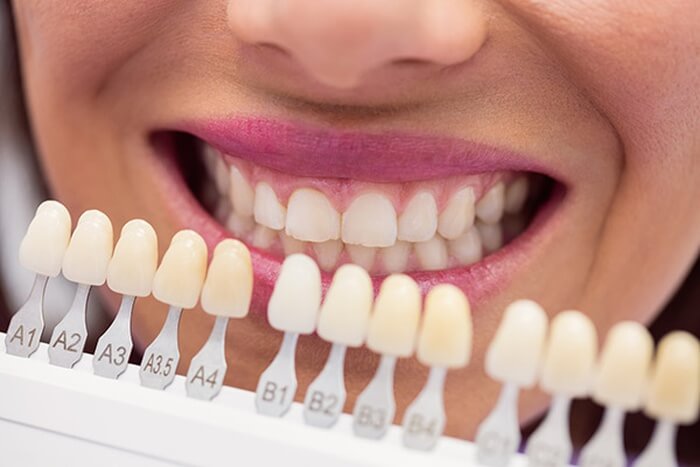 Unterschiede zwischen Zirkonium Veneer und Porzellan Veneer