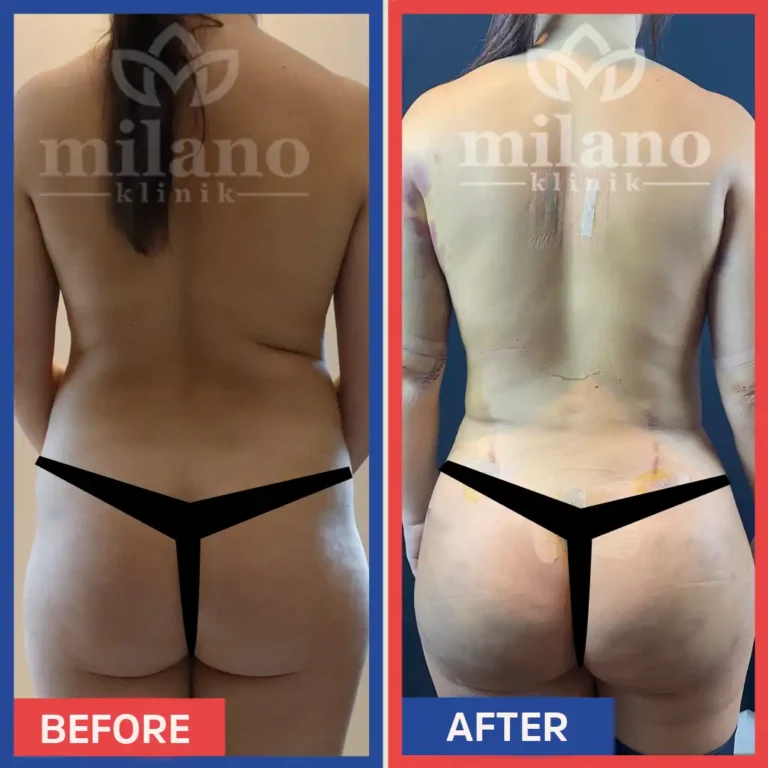 bbl-turkei-vorher-nachher-po-fettabsaugung-kosten-milano-klinik04.webp