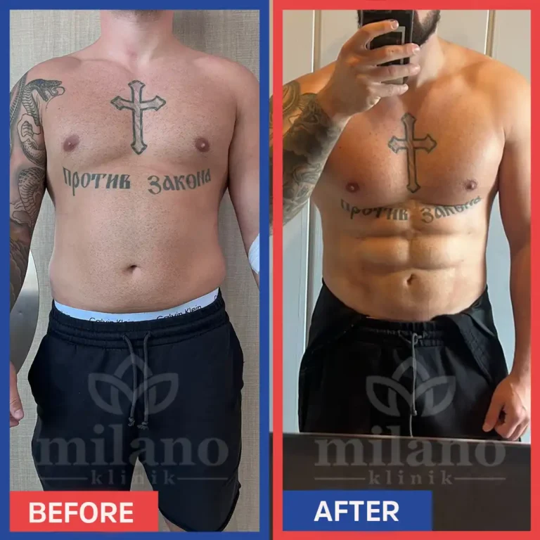 fettabsaugen-bauch-mann-kosten-fettabsaugung-turkei-vorher-nachher-kosten-milano-klinik04-1.webp