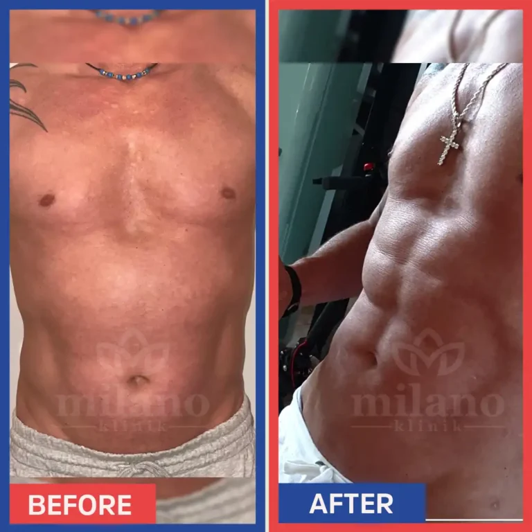 fettabsaugen-bauch-mann-kosten-fettabsaugung-turkei-vorher-nachher-kosten-milano-klinik05-1.webp