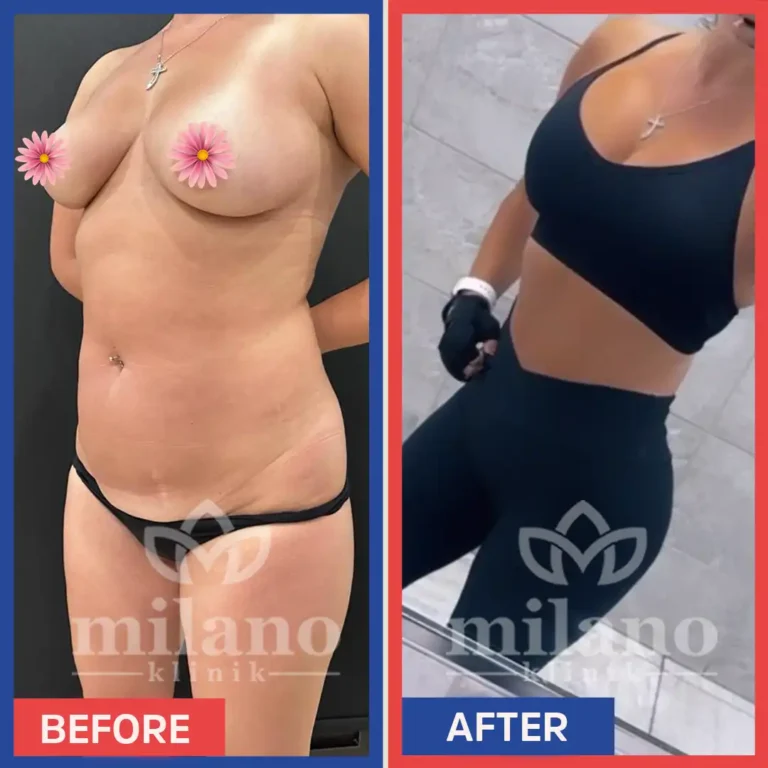 fettabsaugen-brust-implantieren-kosten-turkei-vorher-nachher-milano-klinik02.webp