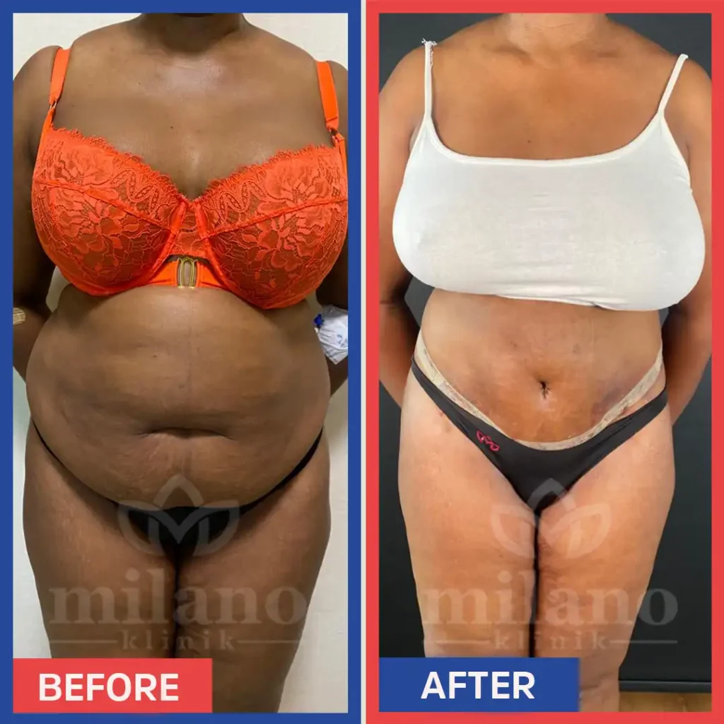 Abdominoplastie 360 Degrés