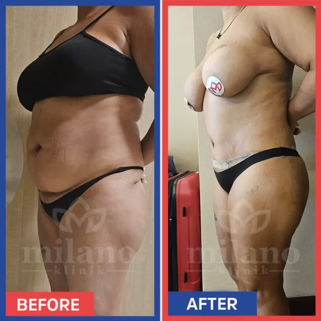 360-derece-liposuction-surgery-fiyatlari-cost-price-turkey-milano-klinik-clinic03.webp