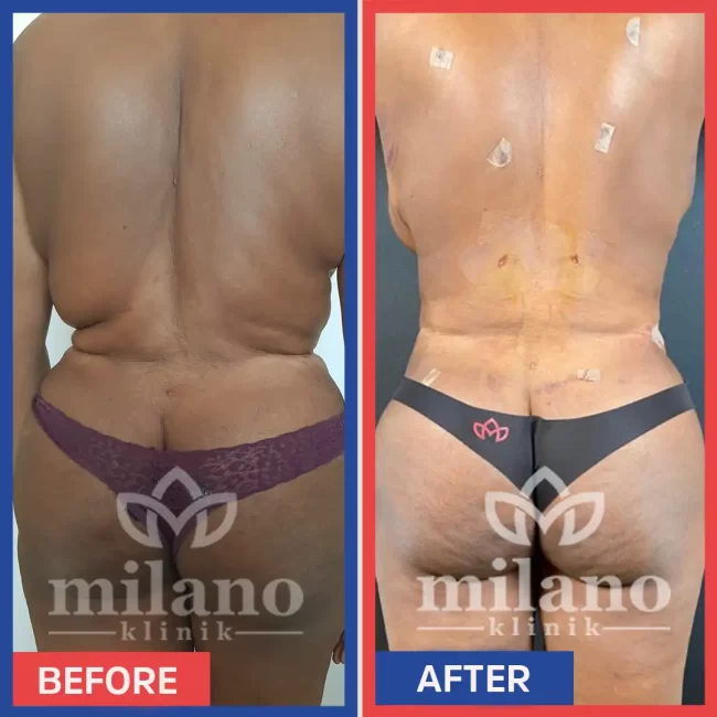 360-derece-liposuction-surgery-fiyatlari-cost-price-turkey-milano-klinik-clinic06.webp