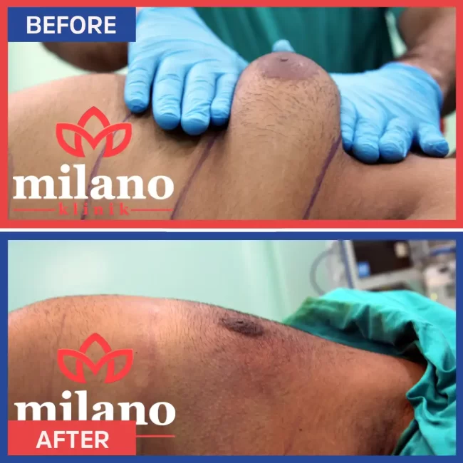 erkeklerde-gugus-yag-aldirma-fiyatlari-milano-klinik