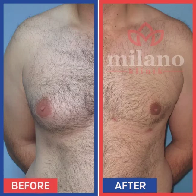 erkeklerde-gugus-yag-aldirma-fiyatlari-milano-klinik01