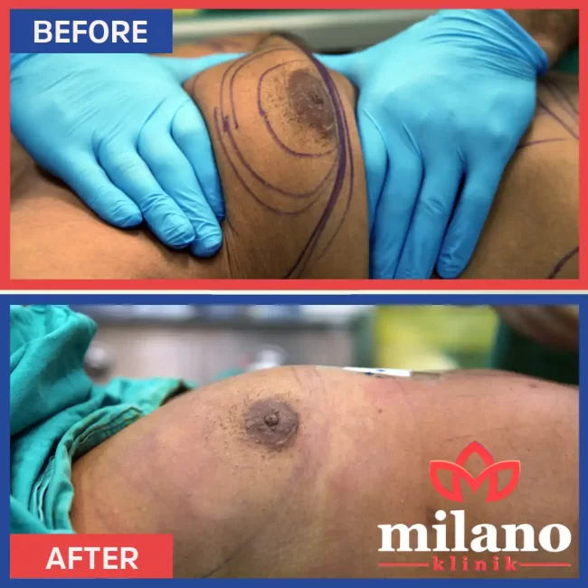 erkeklerde-gugus-yag-aldirma-fiyatlari-milano-klinik02