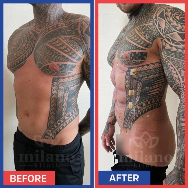 sixpack-ameliyati-liposuction-surgery-fiyatlari-cost-price-turkey-milano-klinik-clinic