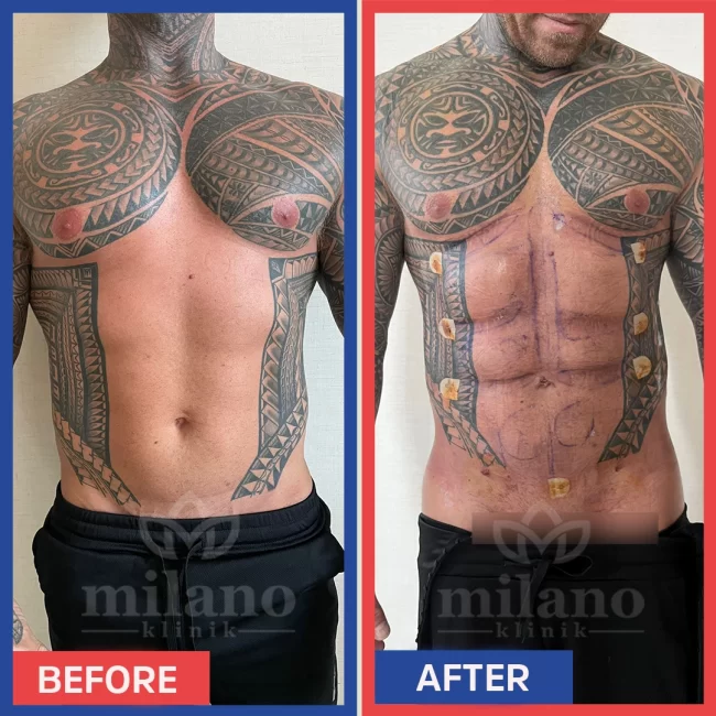 sixpack-ameliyati-liposuction-surgery-fiyatlari-cost-price-turkey-milano-klinik-clinic01
