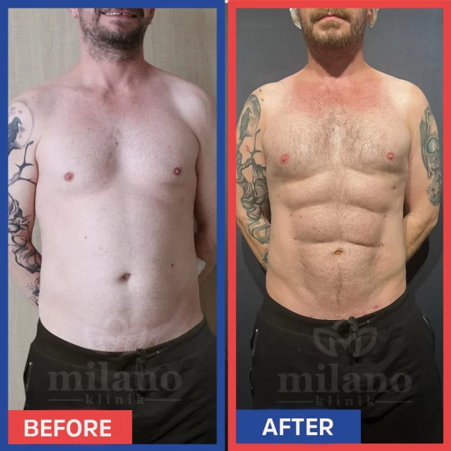 sixpack-ameliyati-liposuction-surgery-fiyatlari-cost-price-turkey-milano-klinik-clinic02