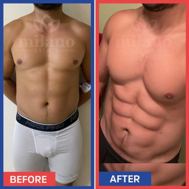 sixpack-ameliyati-liposuction-surgery-fiyatlari-cost-price-turkey-milano-klinik-clinic03