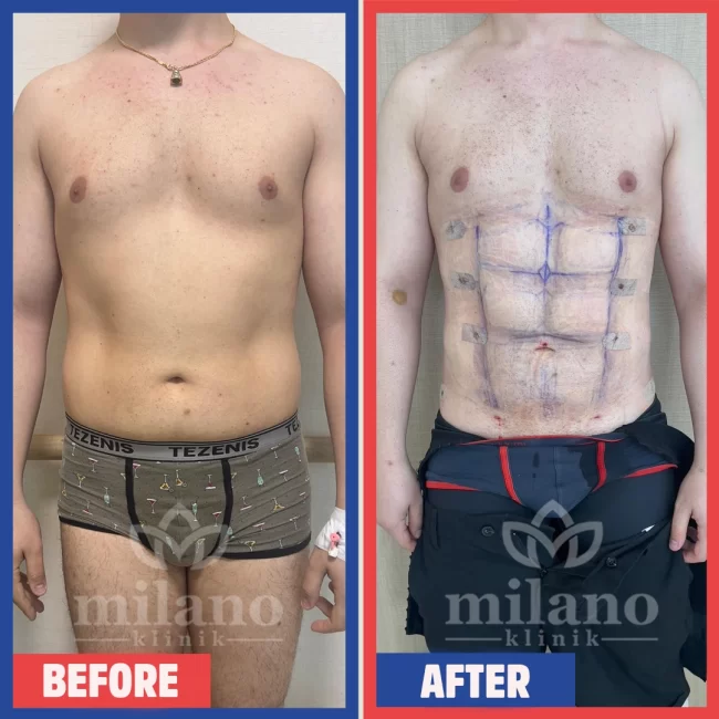 sixpack-ameliyati-liposuction-surgery-fiyatlari-cost-price-turkey-milano-klinik-clinic04