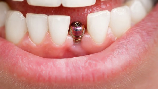 Dentist Tools. Beautiful Young Woman Smile With Closeup Of Tooth Implant For Healthcare Design. Heal